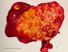 Tumora hepatica maligna